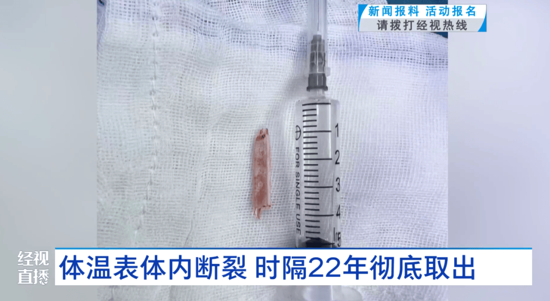 体温表在体内断裂<strong></p>
<p>okex教程</strong>，女子时隔22年彻底取出！医生：庆幸水银不在里面